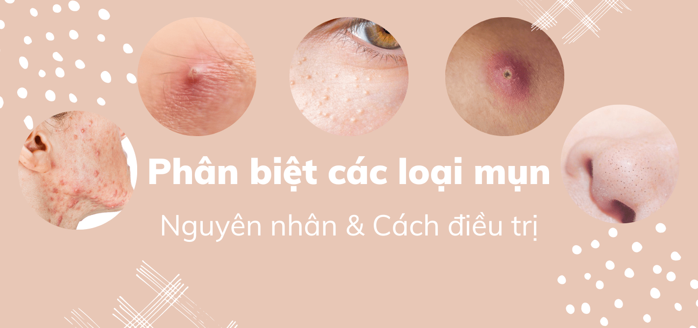 Hình ảnh minh họa sự khác nhau giữa mụn đầu trắng, mụn đầu đen, mụn ẩn và mụn bọc trên trán.